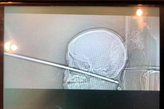 medical miracle
