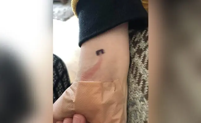 sepsis