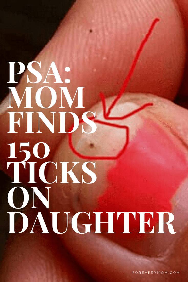 ticks on daughter