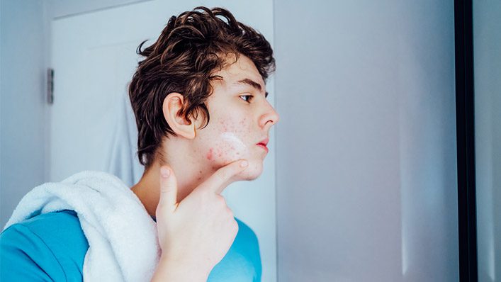 20 Essential Acne Hacks Every Teen Needs To Know